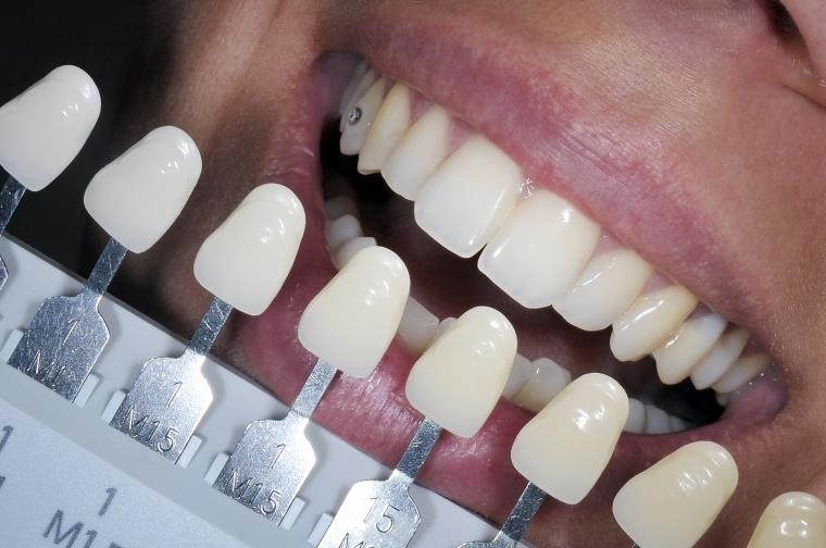 couleur-dent-beaute-dentiste