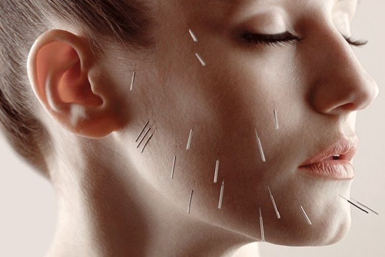acupuntcure esthetique anti rides visage