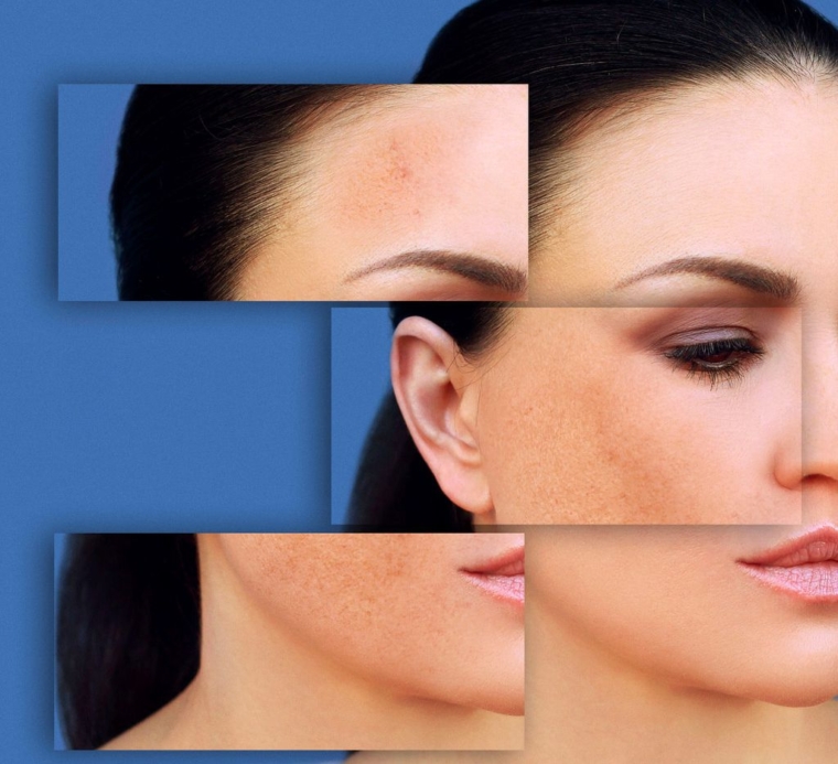 Taches brunes sur le visage citron, huiles essentielles et autres remèdes de grandmère pour
