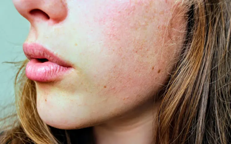 comment traiter la peau sèche du visage